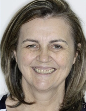 Maria S., 58 anos — antes